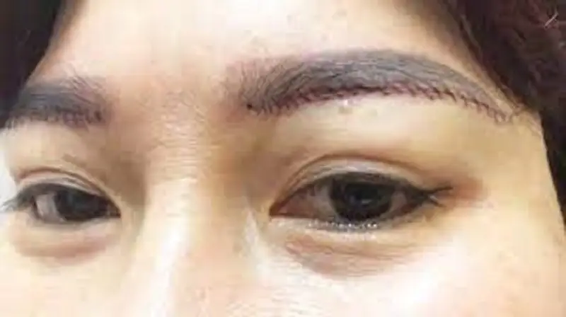 Nâng cung chân mày bị sẹo có thể do kỹ thuật thực hiện