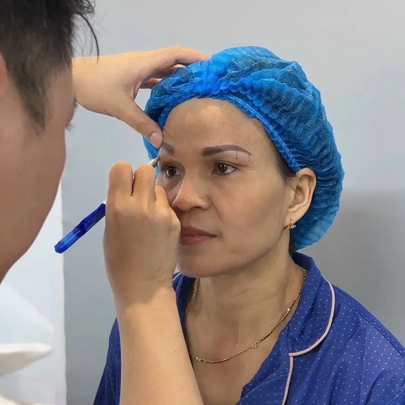 Bác sĩ sẽ thăm khám và đánh dấu vị trí cần khắc phục ở chân mày