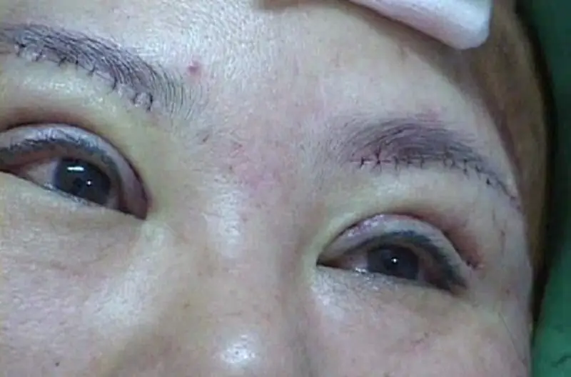 Nâng cung chân mày để lại sẹo dấu hiệu bị hỏng