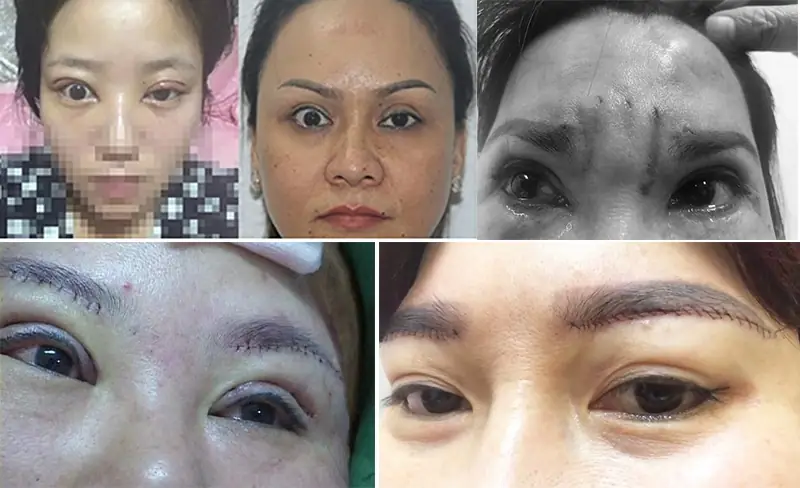 Nâng cung chân mày bị hỏng, nhiễm trùng, mắt trợn