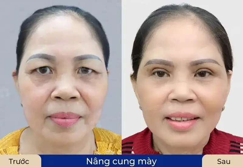 Nâng cung chân mày tại Kangnam kiến tạo cặp chân mày cân đối, tự nhiên