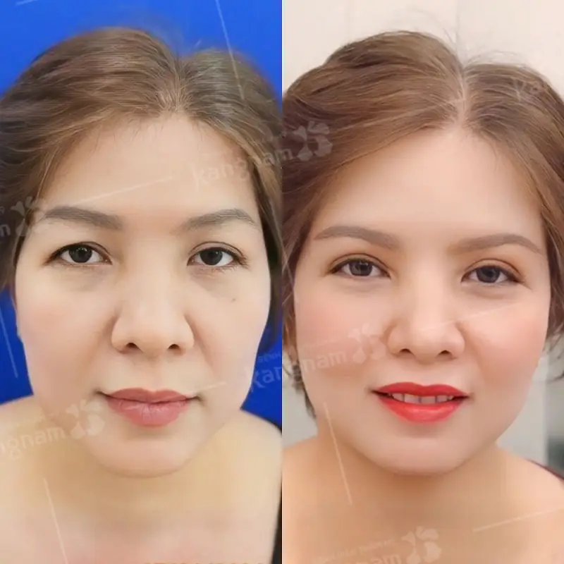 Sau tiểu phẫu khắc hàng được cải thiện tầm nhìn, chân mày nâng cao, rõ nét hơn
