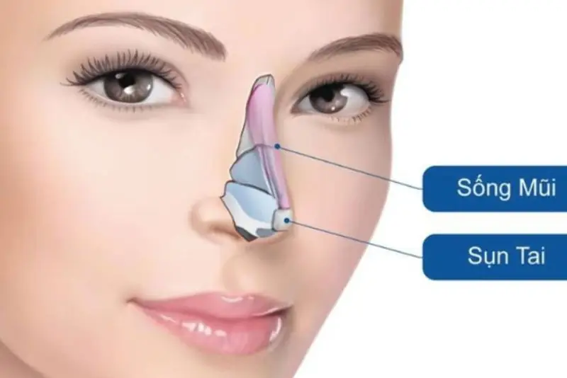 Nâng mũi bọc sụn tai giúp đầu mũi mềm mại