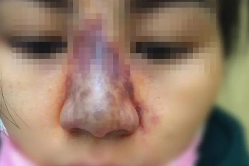 Biến chứng sau nâng mũi do bác sĩ thực hiện sai kỹ thuật, không đảm bảo vô trùng