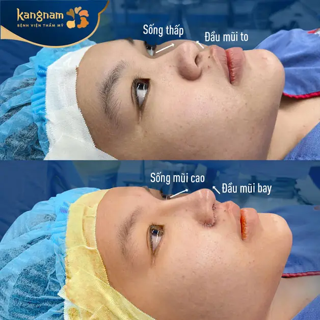 Cận cảnh dáng mũi sau khi vừa thực hiện