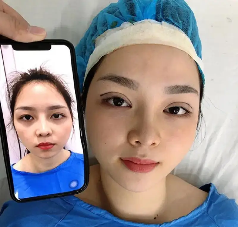 Sau nhấn mí vết thương có thể hơi sưng tấy