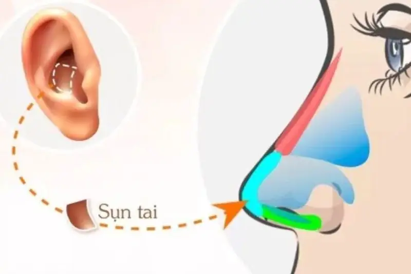 Sụn tai tự thân giảm thiểu