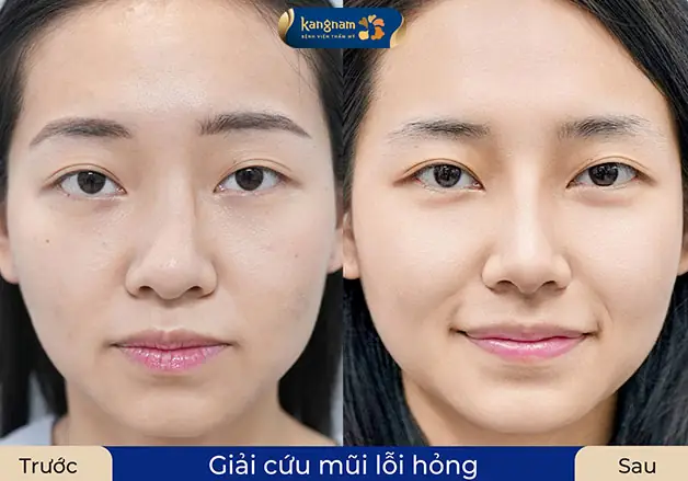 Sống mũi lệch nếu chỉ nâng mũi bọc sụn sẽ không cải thiện triệt để