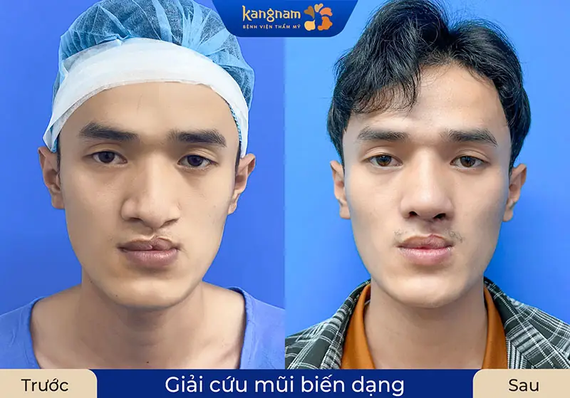 Nâng mũi cấu trúc tái tạo lại toàn bộ dáng mũi