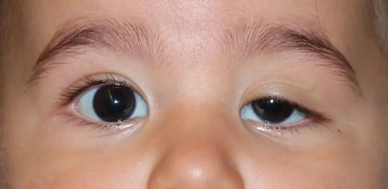 Tình trạng sụp mí bẩm sinh xảy ra khi trẻ vừa sinh ra