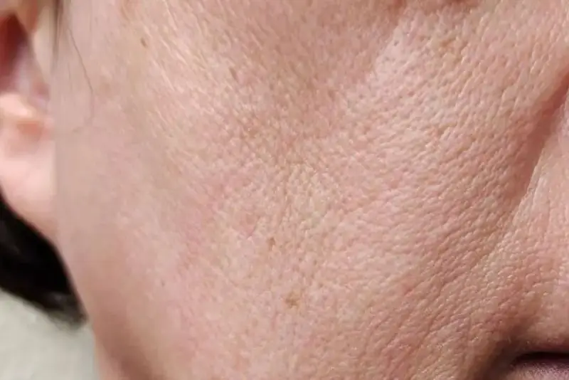 Mô mềm chảy xệ