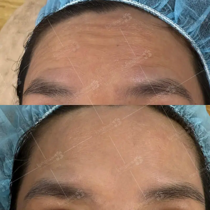 Kết quả tiêm xóa nhăn thấy rõ sau vài ngày