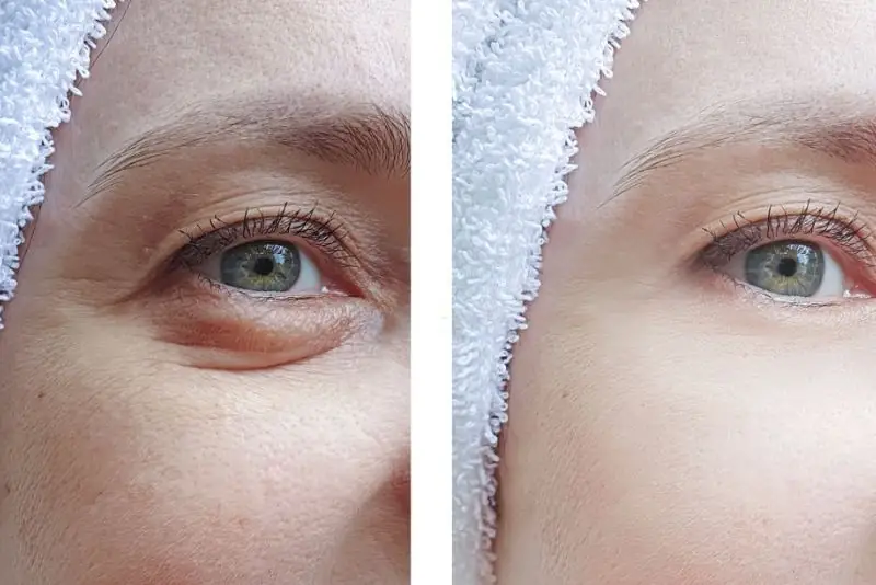 Người có bọng mắt trũng sâu nên cân nhắc tiêm filler