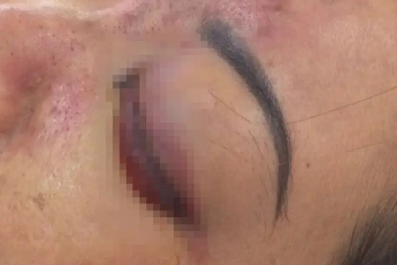 Sưng bầm do tiêm sai lớp mô