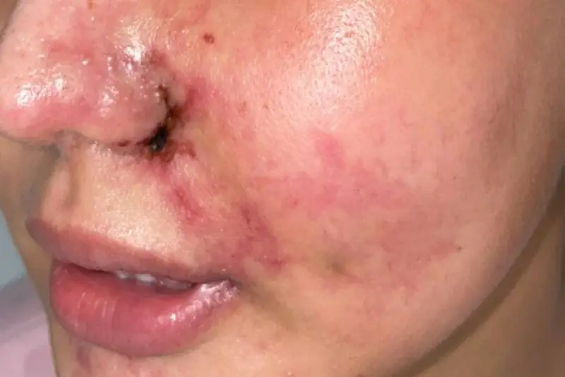 Biến chứng khi sử dụng filler kém chất lượng