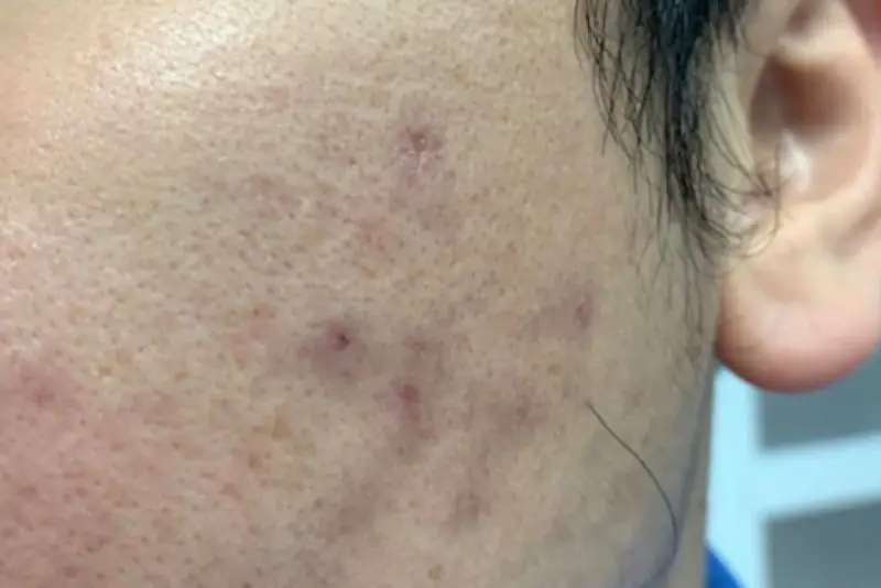 Bầm tím da sau tiêm meso