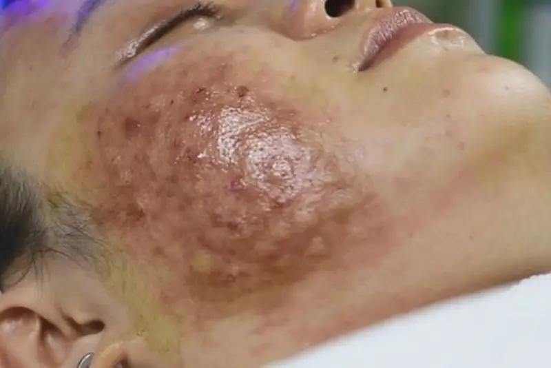 Biến chứng do tiêm meso sai kỹ thuật