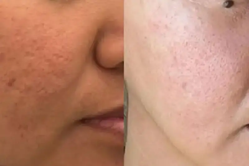 Tiêm meso cải thiện nhẹ tình trạng sẹo rỗ