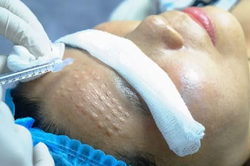 Tiêm meso có thể hỗ trợ điều trị tình trạng sẹo rỗ