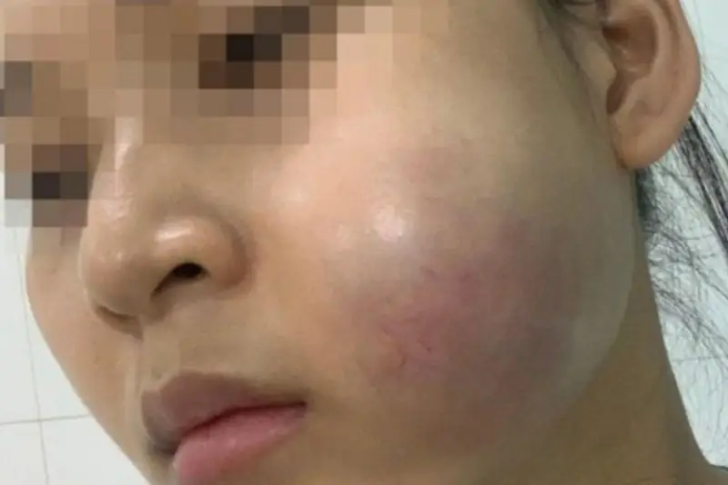 Biến chứng do tiêm filler sai kỹ thuật