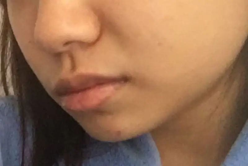 Yếu cơ sau khi tiêm thon gọn hàm sai kỹ thuật