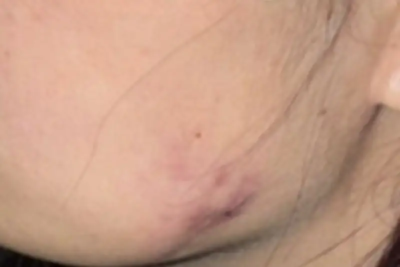 Sưng tấy và bầm tím vùng tiêm