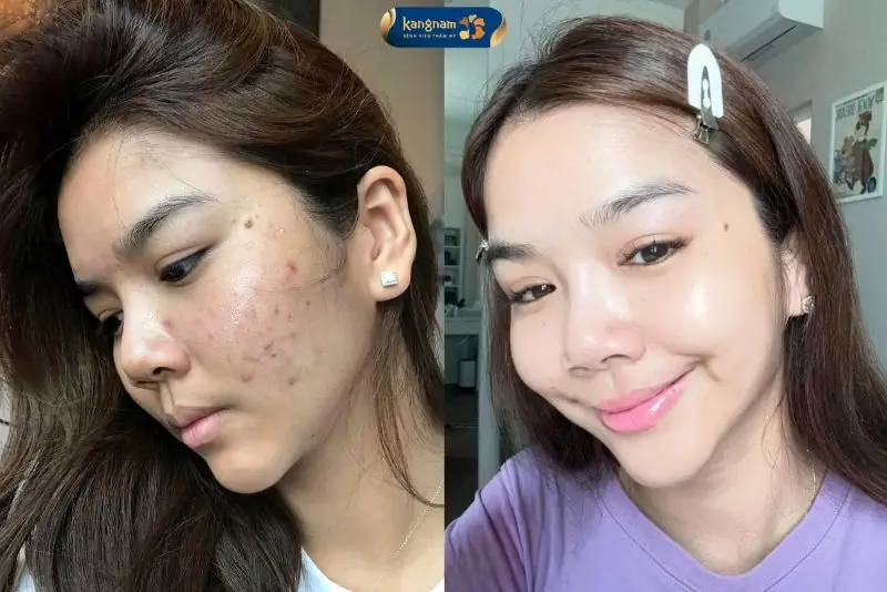 Thâm mụn lâu năm cần điều trị bằng phác đồ chuyên sâu tại viện da liễu