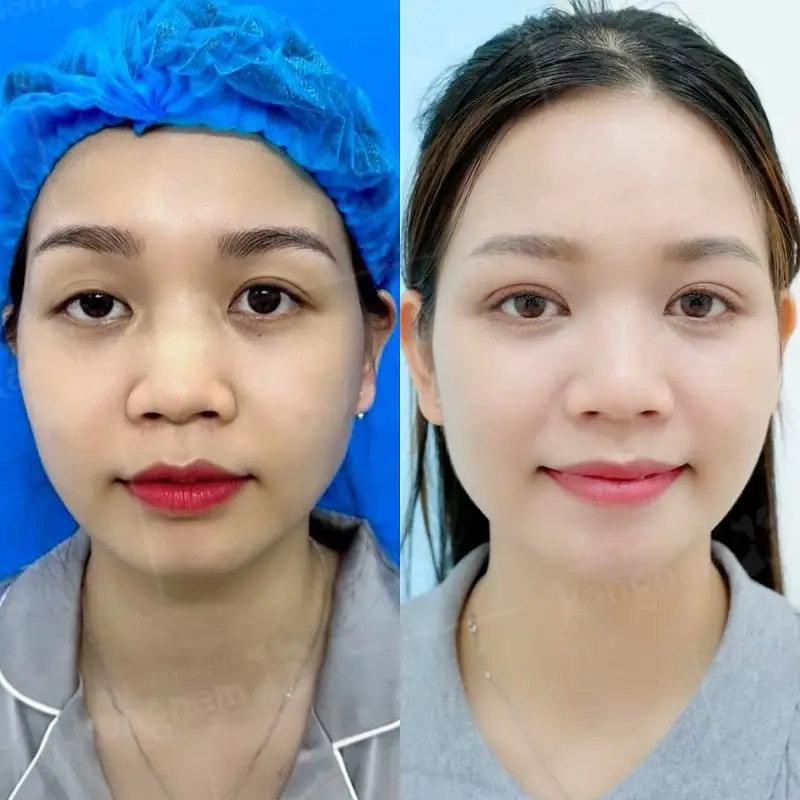 Kết quả cắt mí dựa vào địa chỉ thẩm mỹ uy tín