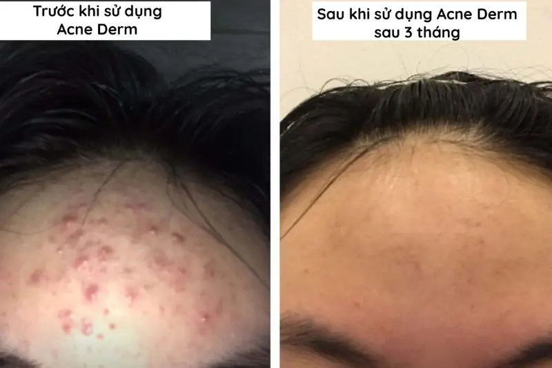 Giảm mụn và thâm sau khi sử dụng