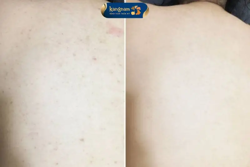 Khách hàng cải thiện thâm mụn sau buổi đầu tiên