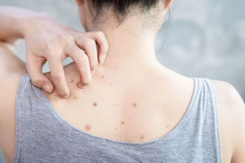 Mụn lưng gây mất thẩm mỹ