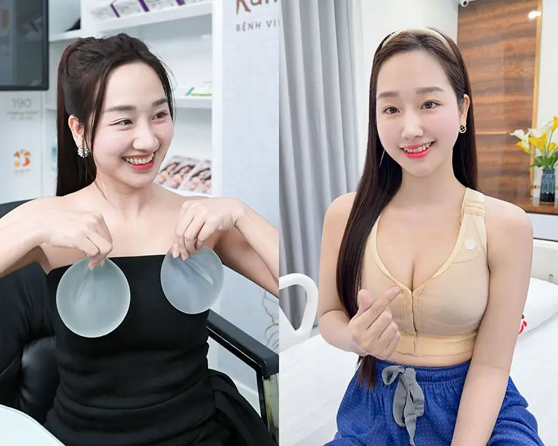 Hồi phục nhanh sau nâng ngực