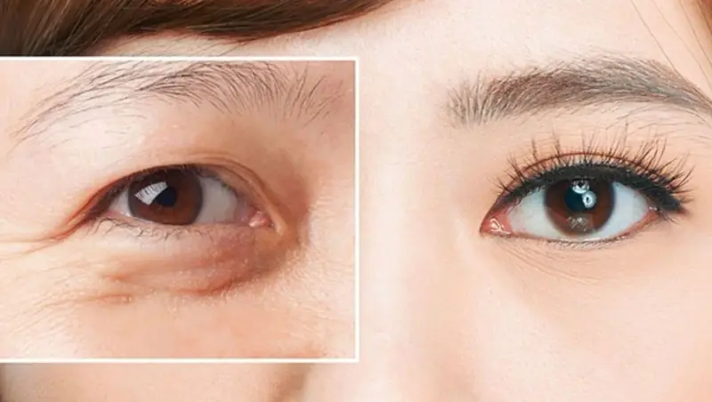 Những người có mí lót, da chùng có thể thực hiện cắt mí full deep