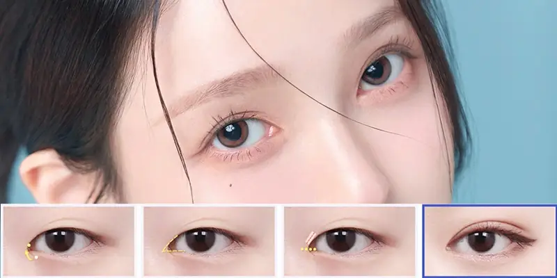 Cắt mí mở rộng góc mắt giúp đôi mắt tro tròn, cân đối hơn