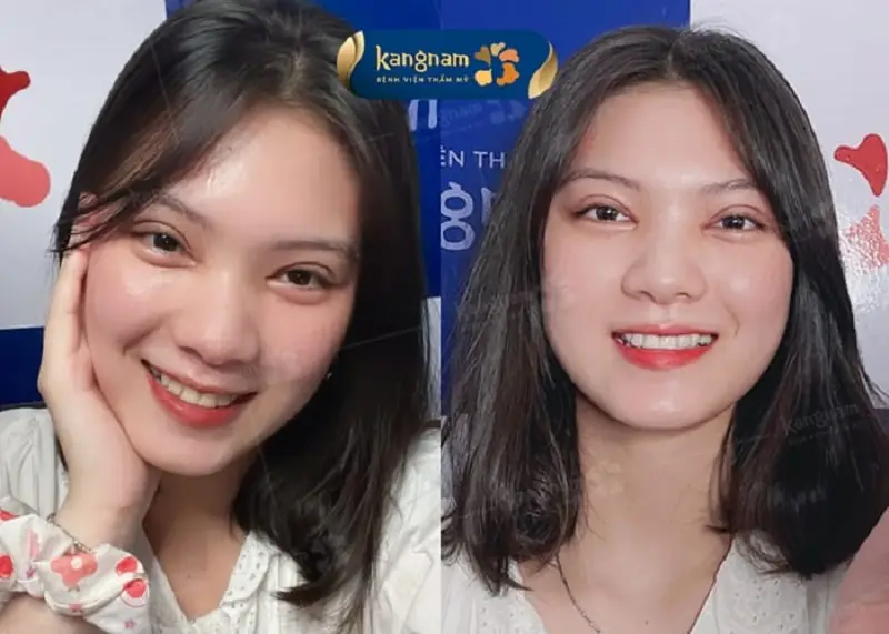 Những người có mí nhỏ, mắt 1 mí có thể thực hiện kỹ thuật mở rộng góc mắt