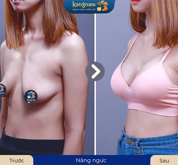 Can thiệp treo sa trễ để cải thiện vòng 1 toàn diện