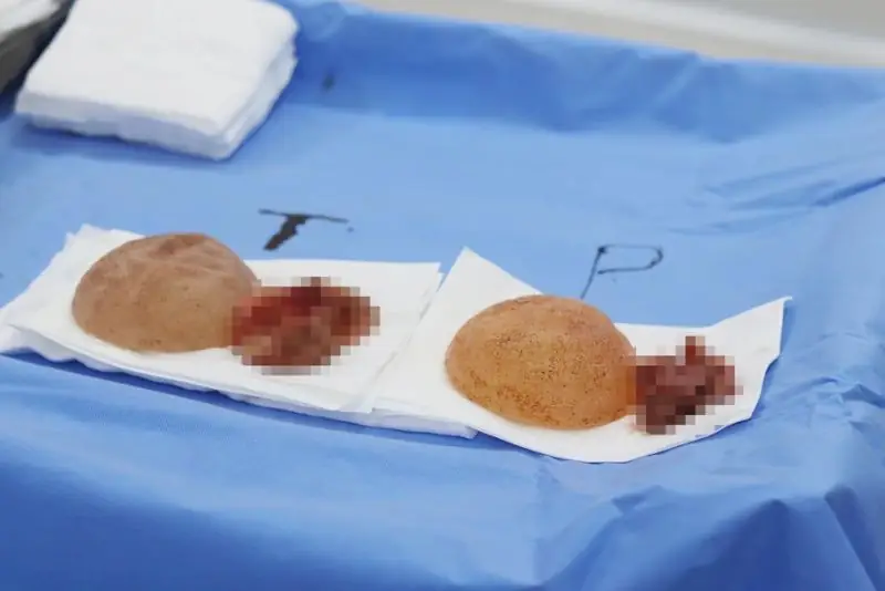 Xuất hiện co bao xơ