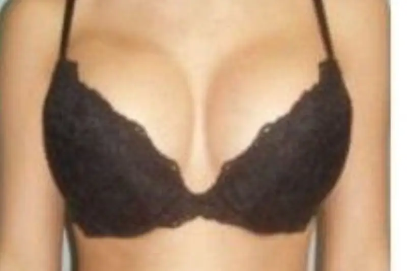 Hai bên ngực không đều do lộ túi ngực