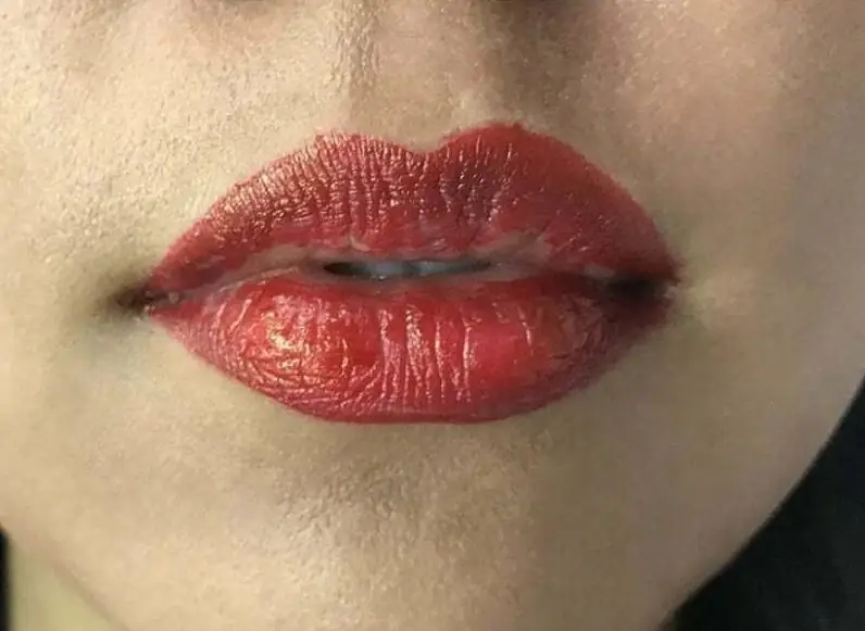 Môi bị sưng tấy, lên màu không đều, loang lổ