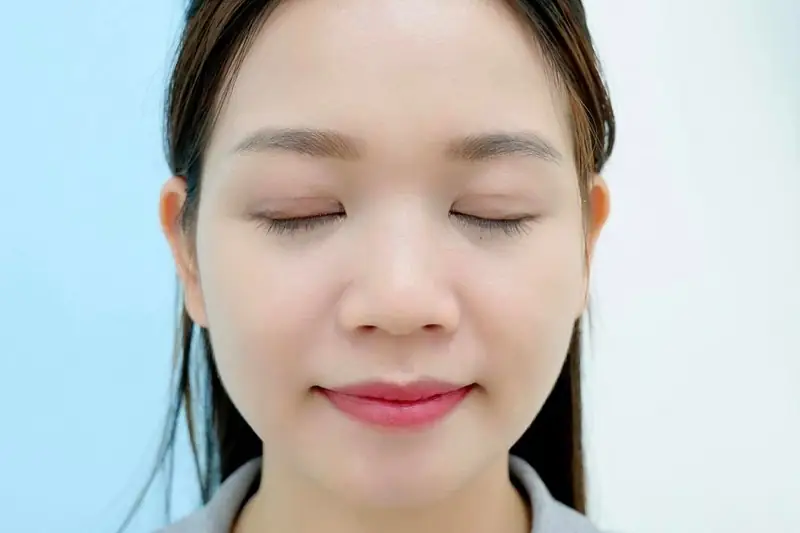 Vết sẹo cắt mí sẽ mờ dần sau 3 - 6 tháng