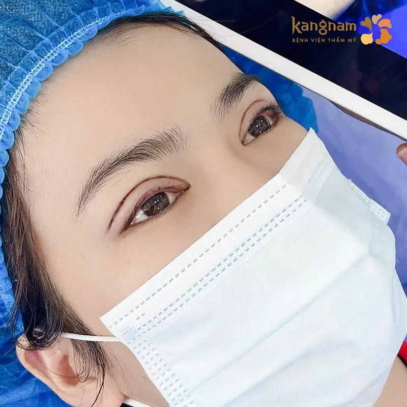 Sau cắt mí hình thành sẹo là hiện tượng thường gặp