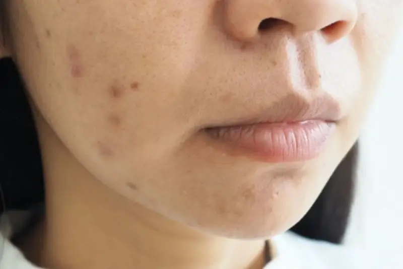 Thâm mụn lâu năm khá khó điều trị