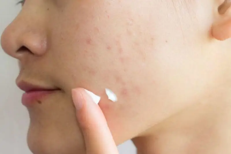 Chăm sóc da sau điều trị an toàn