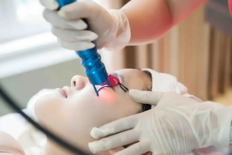 Laser tác động trực tiếp vào melanin