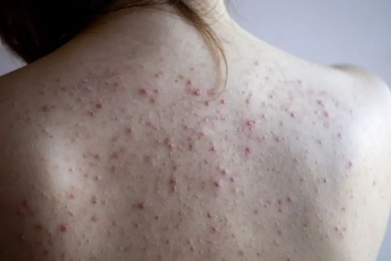 Nếu mụn lưng nhiều