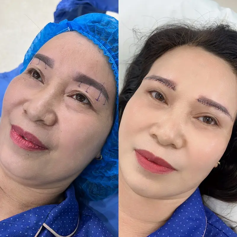 Chân mày khi mới tiểu phẫu sẽ hơi sưng tấy những ngày đầu