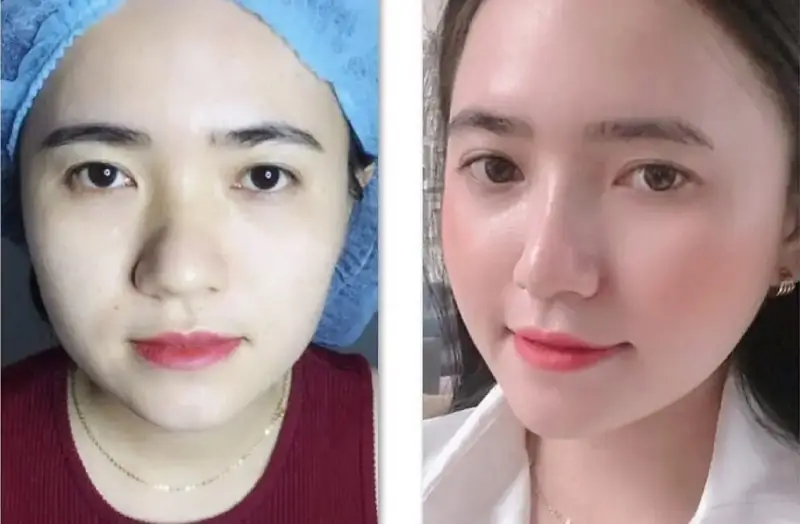 Vùng mũi cần thời gian phục hồi sau khi căng chỉ