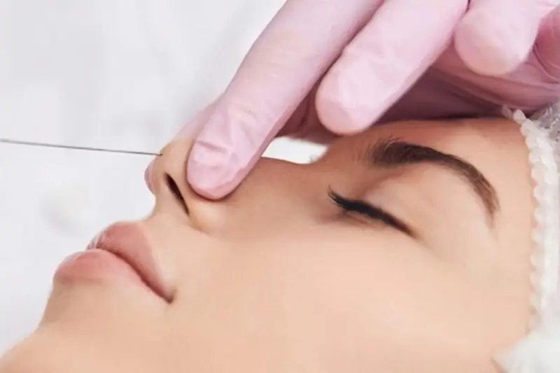 Thời gian mũi lành phụ thuộc vào loại chỉ sử dụng