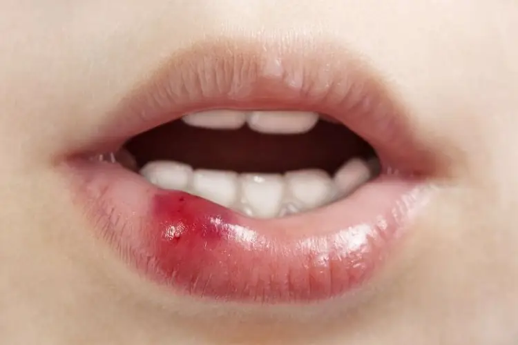 Môi bị nổi mụn nước do nhiễm virus