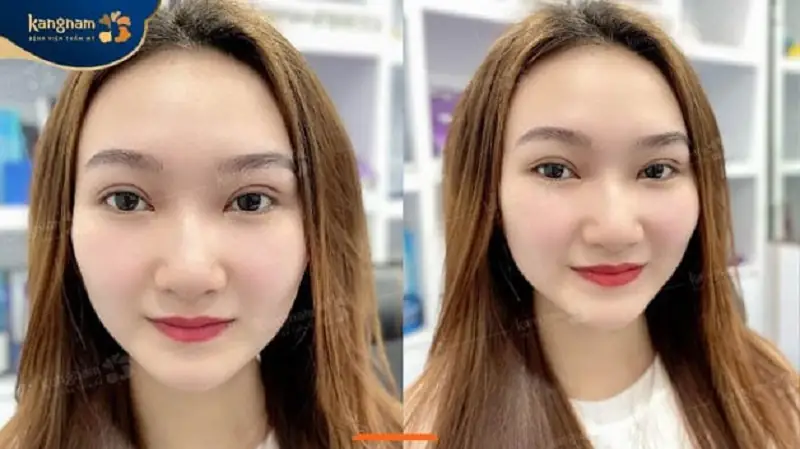 Khách hàng sở hữu đôi mắt to tròn tự nhiên và cân đối sau cắt mí và mở góc mắt